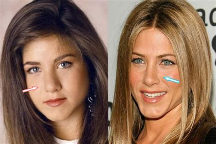 Did Jennifer Aniston Have Nose Surgery